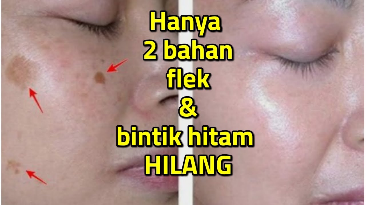 4 Solusi Praktis Menghilangkan Flek Hitam dan Sel Kulit Mati Secara Alami