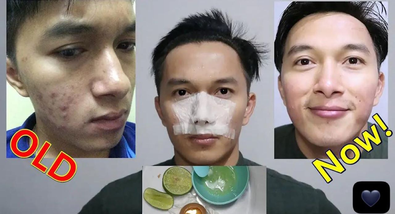 3  Masker Alami Penghilang Bekas Jerawat Hitam di Wajah Agar Glowing