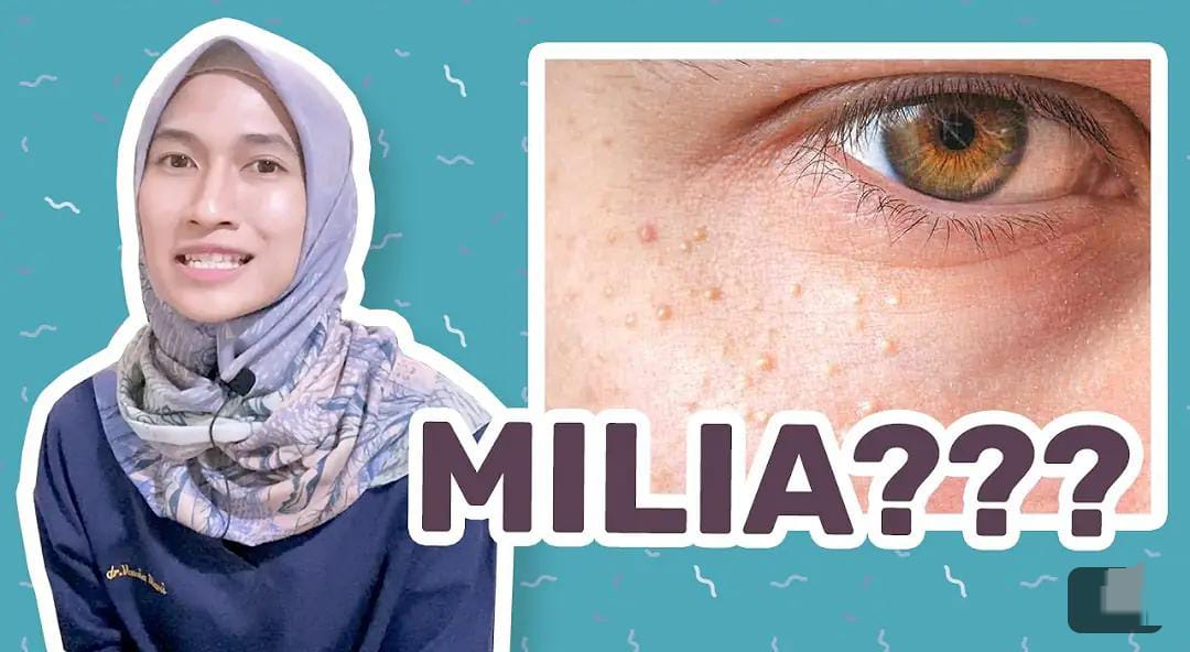 3 Cara Menghilangkan Milia Menurut Dermatologist dan Ahli Kecantikan Kulit, Kulit Glowing Tanpa Biaya Mahal