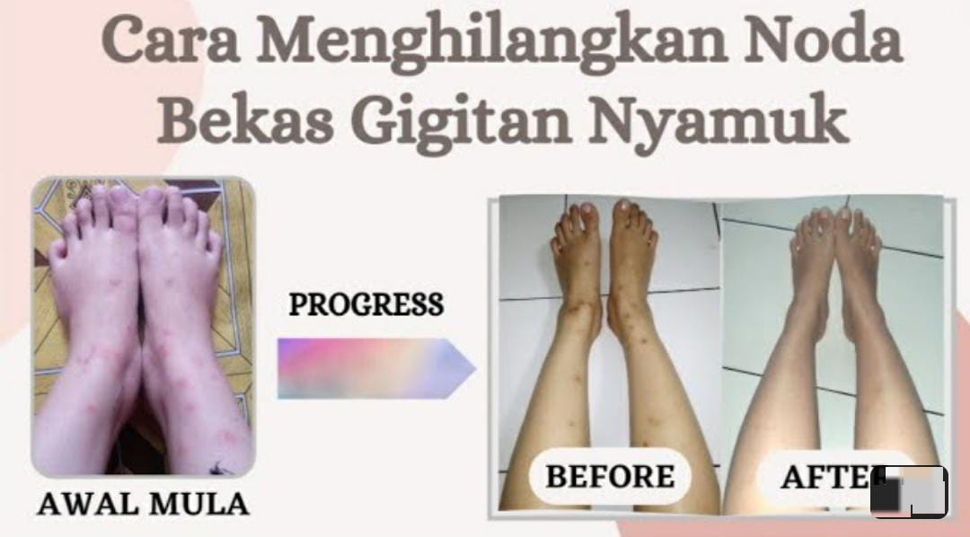 4 Cara Menghilangkan Bekas Gigitan Nyamuk Menghitam di Kaki Seperti Koreng, Kulit jadi Putih Tanpa Noda