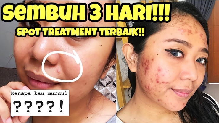 5 Produk Acne Spot Care yang Bagus untuk Perawatan Kulit Berjerawat, Samarkan Bekasnya Sekaligus!