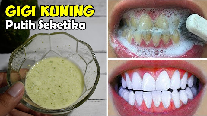 3 Bahan Alami yang Bagus untuk Menghilangkan Gigi Kuning, Bikin Bau Mulut Hilang dan Gigi Putih Permanen