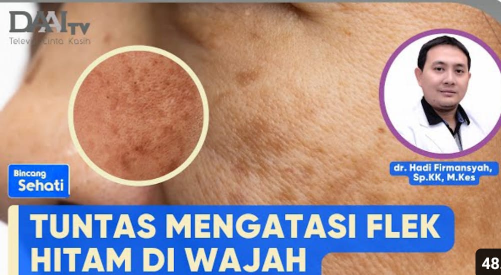 3 Rekomendasi Skincare Wardah untuk Menghilangkan Flek Hitam, Solusi Cerdas Wajah Bersih Dalam Sekali Pakai!