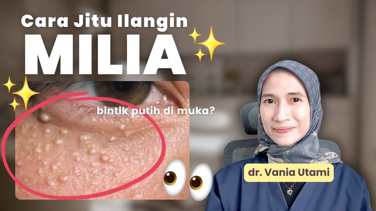 3 Cara Alami Menghilangkan Milia di Dekat Mata Dengan Mudah