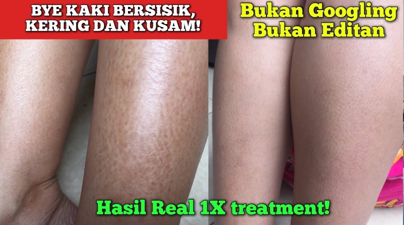 4 DIY Cara Menghilangkan Kulit Kering Bersisik dengan Bahan Alami, Langsung Halus dan Cerah Cuma Pakai Ini!