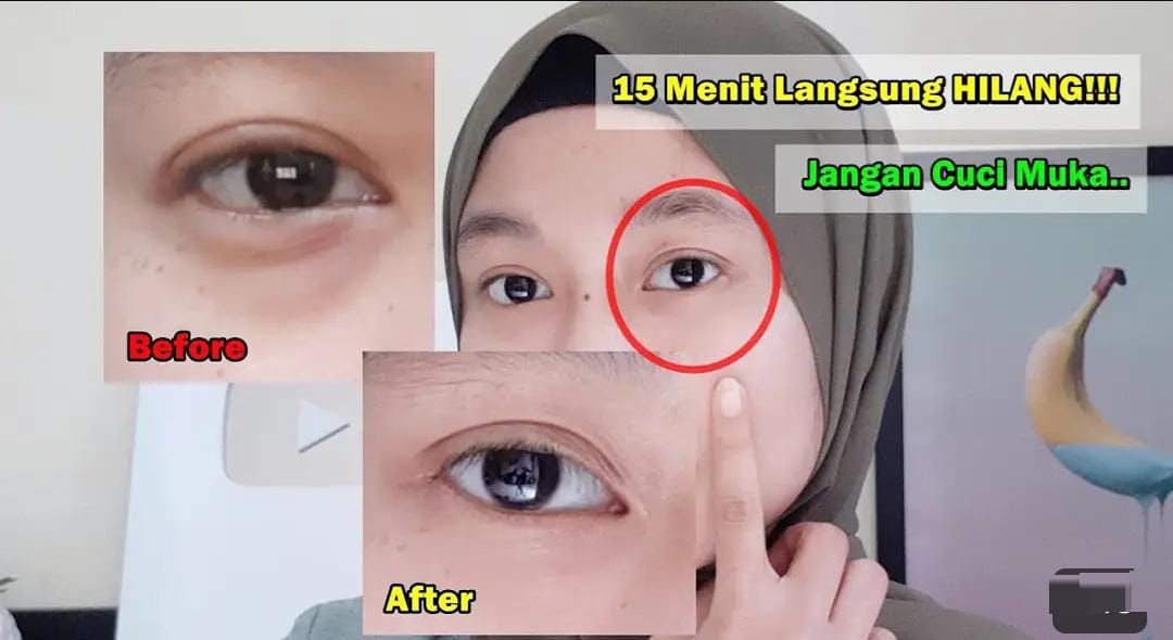 3 Cara Menghilangkan Kantung Mata Secara Permanen, Kulit Bebas Kendur dan Hitam Cuma Pakai Bahan Dapur