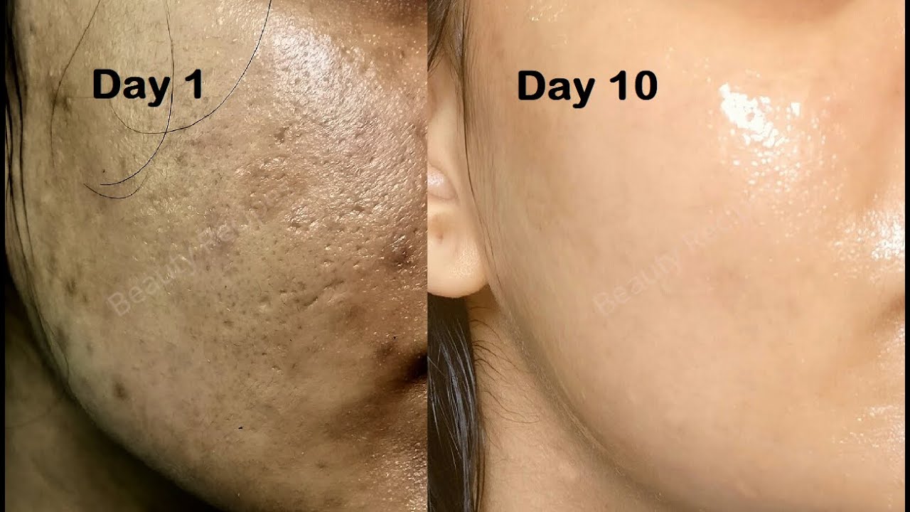 Cara Merapatkan Pori-Pori yang Terbuka Agar Mengecil dan Mulus, Cuma Pakai Bahan Dapur Aja!