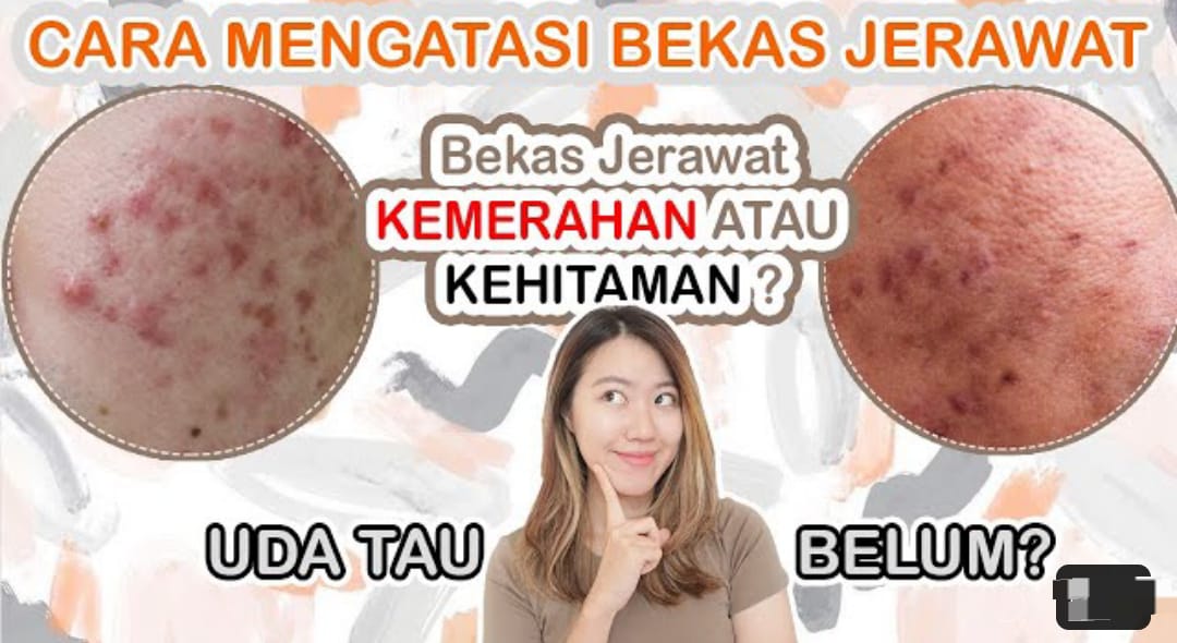 5 Masker Untuk Menghilangkan Bekas Jerawat Hitam Membandel Secara Alami ...