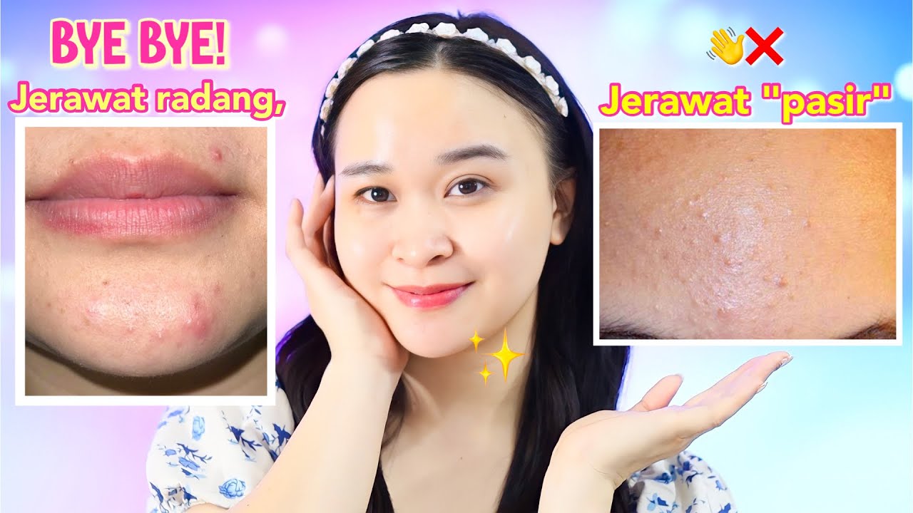 Kulit Jerawat dan Kemerahan? Ini 4 Rekomendasi Skincare untuk Memperbaiki Skin Barrier Dibawah 50 Ribuan!