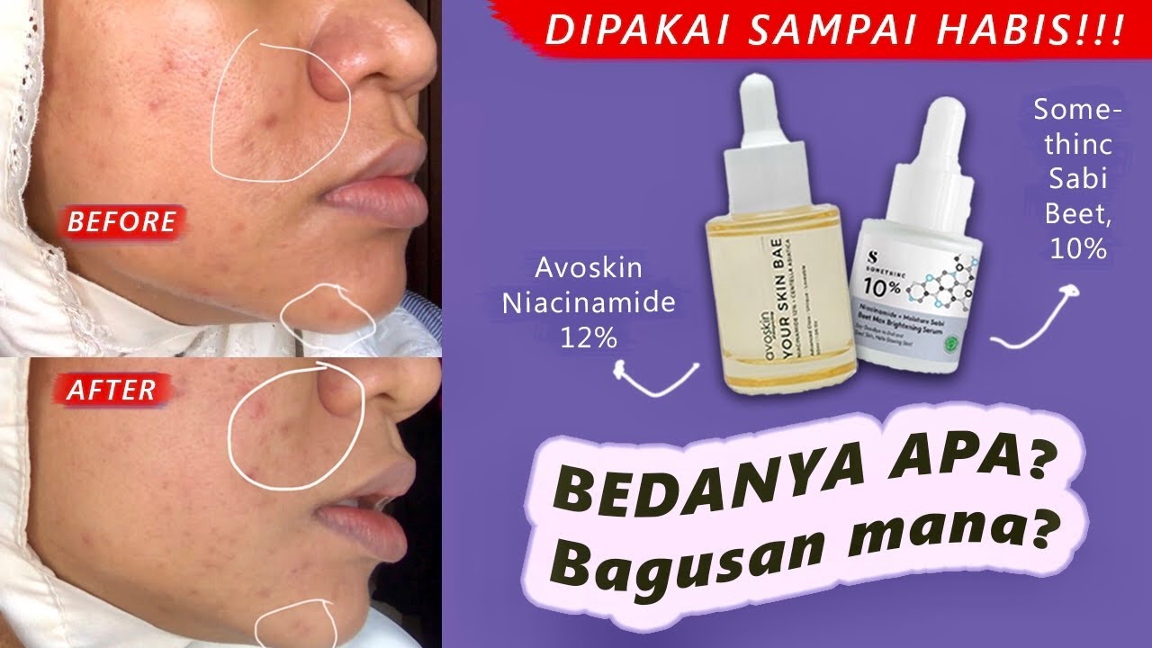 Serum Niacinamide Avoskin vs Somethinc! Battle Mana yang Paling Bagus dan Ampuh Cerahkan Wajah?