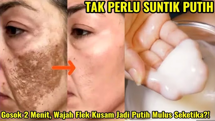 3 Cara Cepat Menghilangkan Flek Hitam di Wajah dalam 1 Hari, Cuma Pakai Bumbu Dapur Bikin Glowing Awet Muda