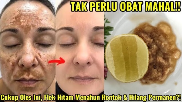 3 Bahan Alami untuk Menghilangkan Flek Hitam Menahun Paling Ampuh, Efektif Kulit Putih Glowing Rata, Awet Muda