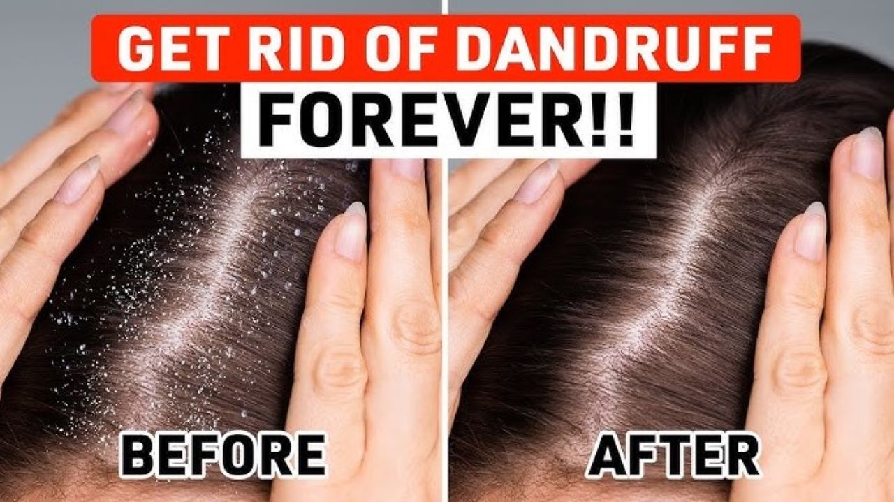 Cara Pakai Lidah Buaya untuk Mengatasi Ketombe, 3 Bahan Bikin Kulit Kepala Bersih