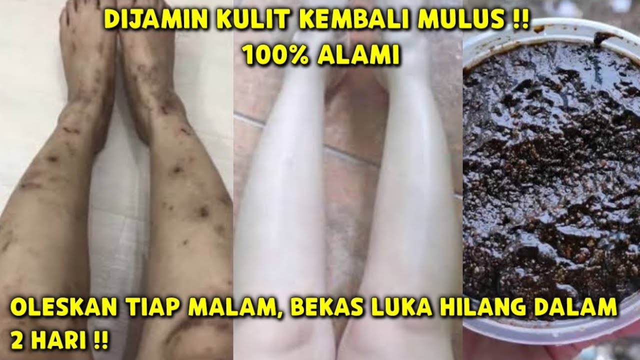 Tips Mudah Hilangkan Bekas Koreng Hitam Permanen Secara Alami, Solusi Kulit Putih dan Mulus Kembali