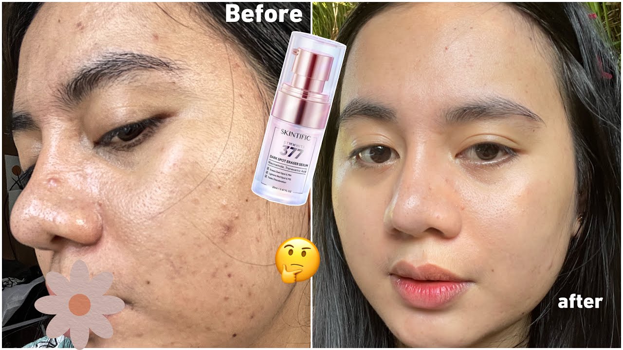 4 Rekomendasi Serum Untuk Kulit Kering Dan Flek Hitam, Bikin Wajah ...