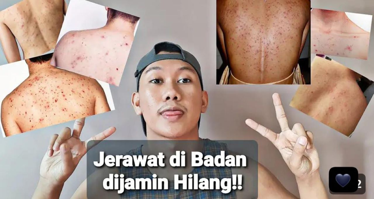 3 Cara Menghilangkan Jerawat Punggung Secara Alami Agar Tidak Muncul Lagi