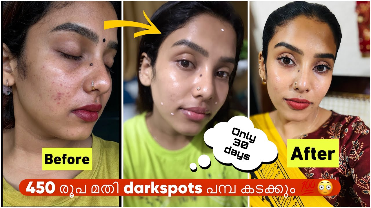 Punya Flek Hitam? Ini 3 Skincare untuk Menghilangkan Flek Hitam yang Ampuh Lagi Promo di Alfamart