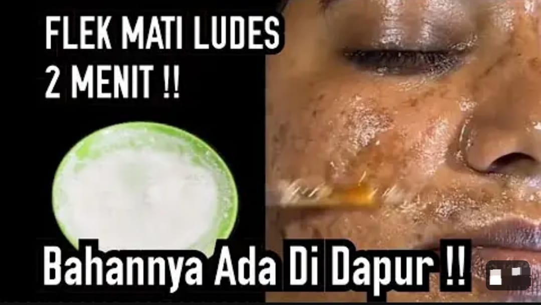 Rahasia Wajah Bebas Flek Hitam di Pipi Tanpa Pakai Skincare Mahal, Kulit Jadi Glowing Cuma Pakai Bahan Dapur