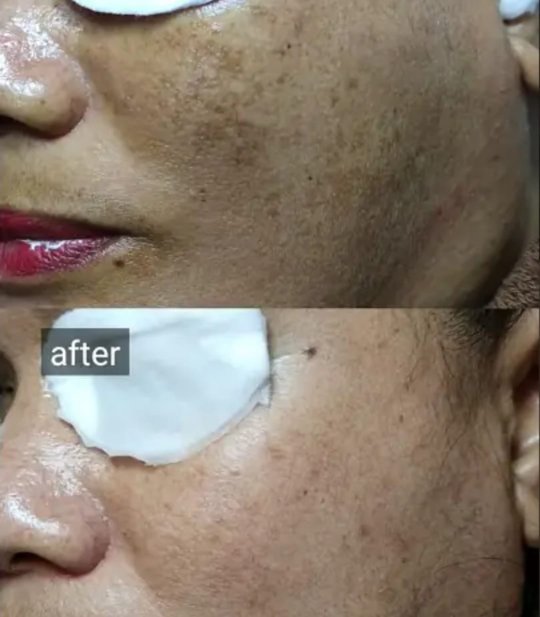 Hilangkan Flek Hitam Membandel Dalam Semalam! Ini 5 Cara Menghilangkan Melasma yang Paling Efektif Bikin Putih