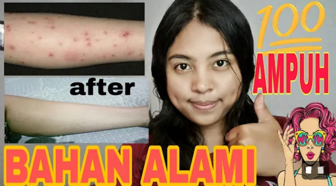 2 Cara Menghilangkan Bekas Gatal yang Menghitam di Kaki Secara Alami dan Permanen, Rahasia Putih Bebas Noda