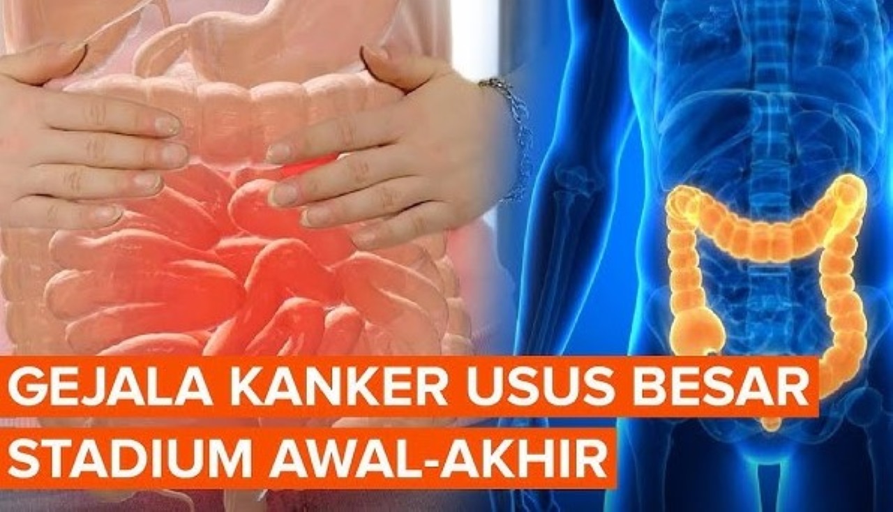 Wajib Tahu! 3 Langkah Gejala dari Kanker Usus Besar dan Cara Mengobatinya Sesuai dengan Gejala yang Dialami