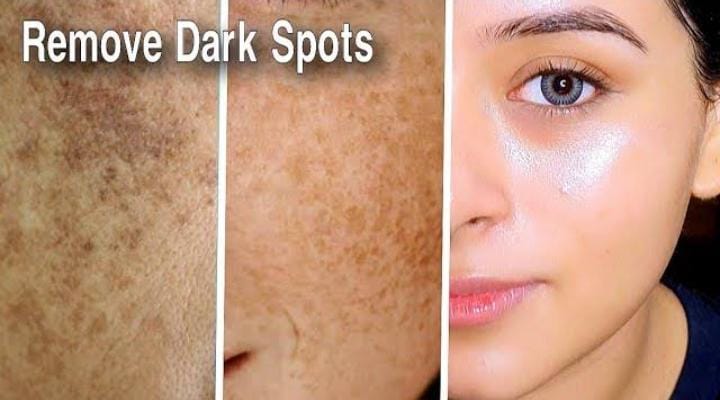 Cara Pudarkan Flek Hitam Pakai 3 Bahan Dapur, Tips Mudah Glowing Permanen Tanpa Skincare Mahal