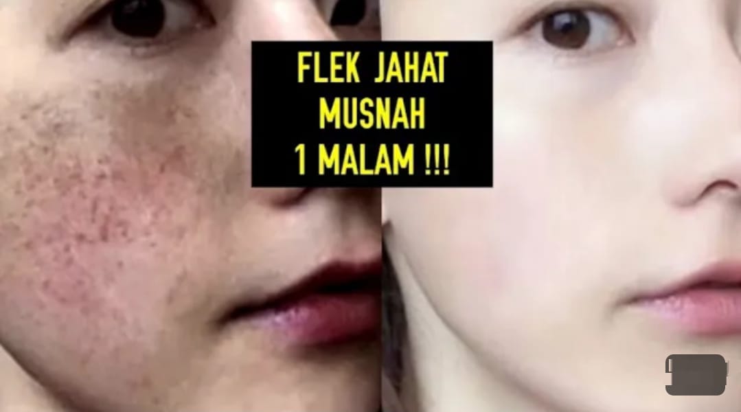 Apa Saja Bahan Alami untuk Menghilangkan Flek Hitam di Wajah? Ikuti Cara Pakai Biar Wajah Putih Mulus Permanen