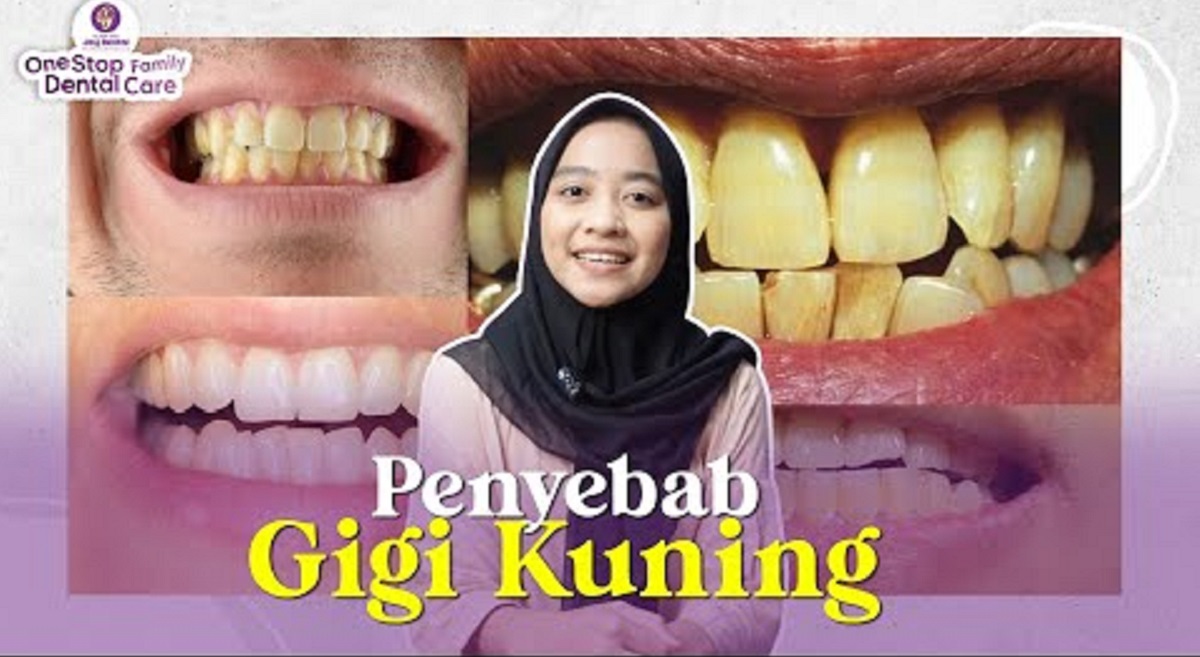 Inilah Penyebab Karang Gigi Kuning Bisa Muncul, Pahami Resiko dan Cara Mengatasinya