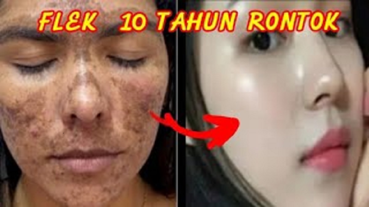 Cara Ampuh Hempaskan Flek Hitam Menahun dengan 3 Bahan, Tips Bikin Kulit Mulus Tanpa Noda