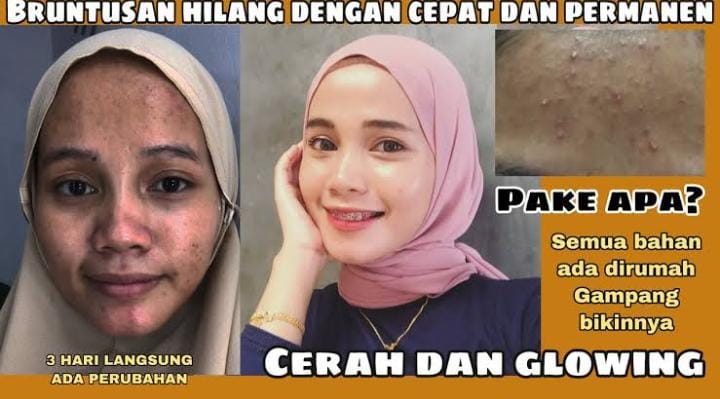 3 Masker Alami untuk Menghilangkan Beruntusan, Rahasia Wajah Mulus dan Glowing Tanpa Skincare Mahal