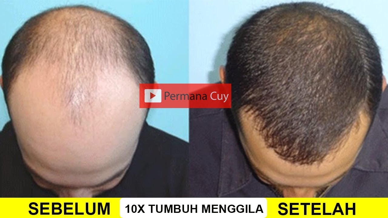 4 Makanan Tinggi Vitamin untuk Menumbuhkan Rambut Botak, Cegah Kerontokan dan Uban Tanpa Perawatan Salon