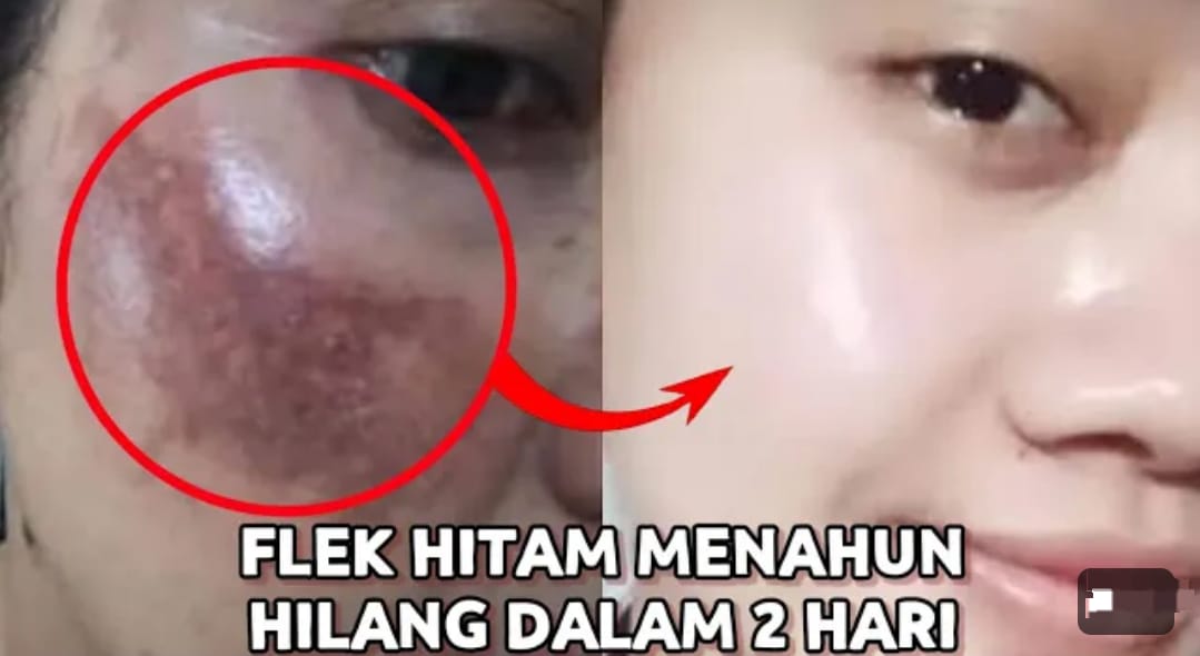 Begini 3 Cara Hilangkan Flek Hitam Di Wajah Secara Alami Dalam 1 Malam