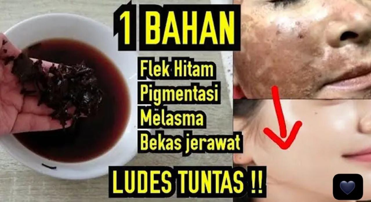 2 Bahan Dapur untuk Menghilangkan Flek Hitam yang Membandel, Kulit Jadi Glowing!