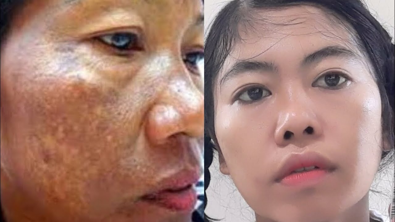 3 Cara Menghilangkan Flek Hitam dengan Masker Lidah Buaya, Rahasia Kulit Mulus Bebas Kerutan Tanpa Skincare