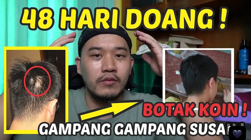 2 Cara Menumbuhkan Rambut Pitak dengan Rosemary Oil yang Benar