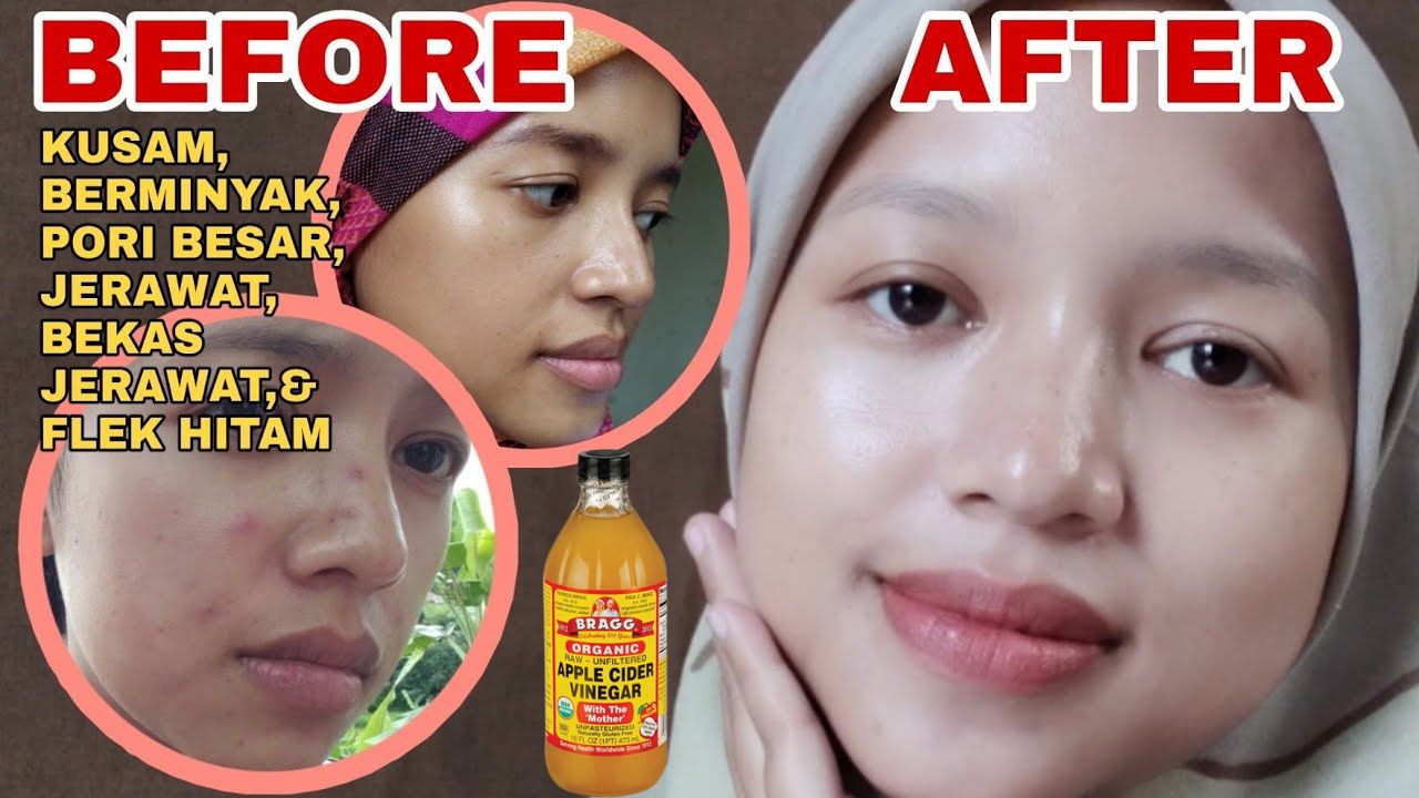 Begini 3 Cara Menghilangkan Flek Hitam dengan Cuka Apel, Bikin Wajah Glowing Putih Bebas Kerutan