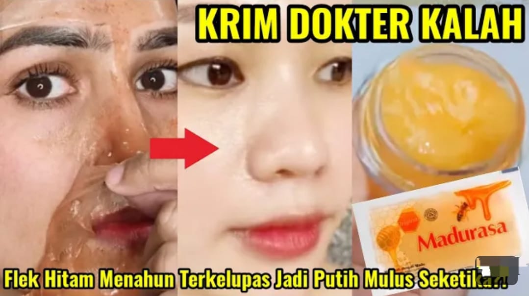 Bagaimana Cara Menghilangkan Flek Hitam di Muka yang Cepat? Ikuti 3 Langkah Wajah jadi Mulus Bebas Noda Hitam