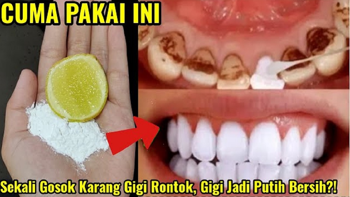 3 Cara Efektif Membersihkan Karang Gigi secara Alami, Ini Bahaya Karang Gigi Jika Tidak Ditangani