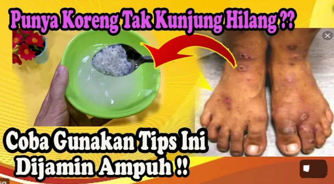 3 Cara Menghilangkan Bekas Koreng di Kaki yang Sudah Lama dan Menghitam, Kulit jadi Putih Kenyal Bebas Noda