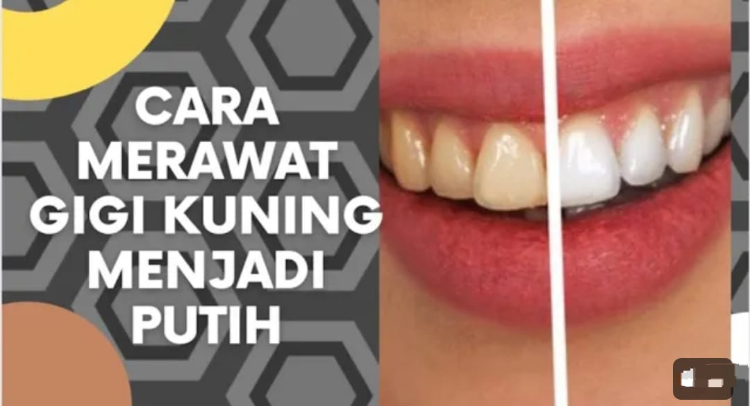 Inilah 4 Cara Memutihkan Gigi Kuning yang Membandel Secara Alami, Gigi Putih Permanen dan Bebas Bau Mulut