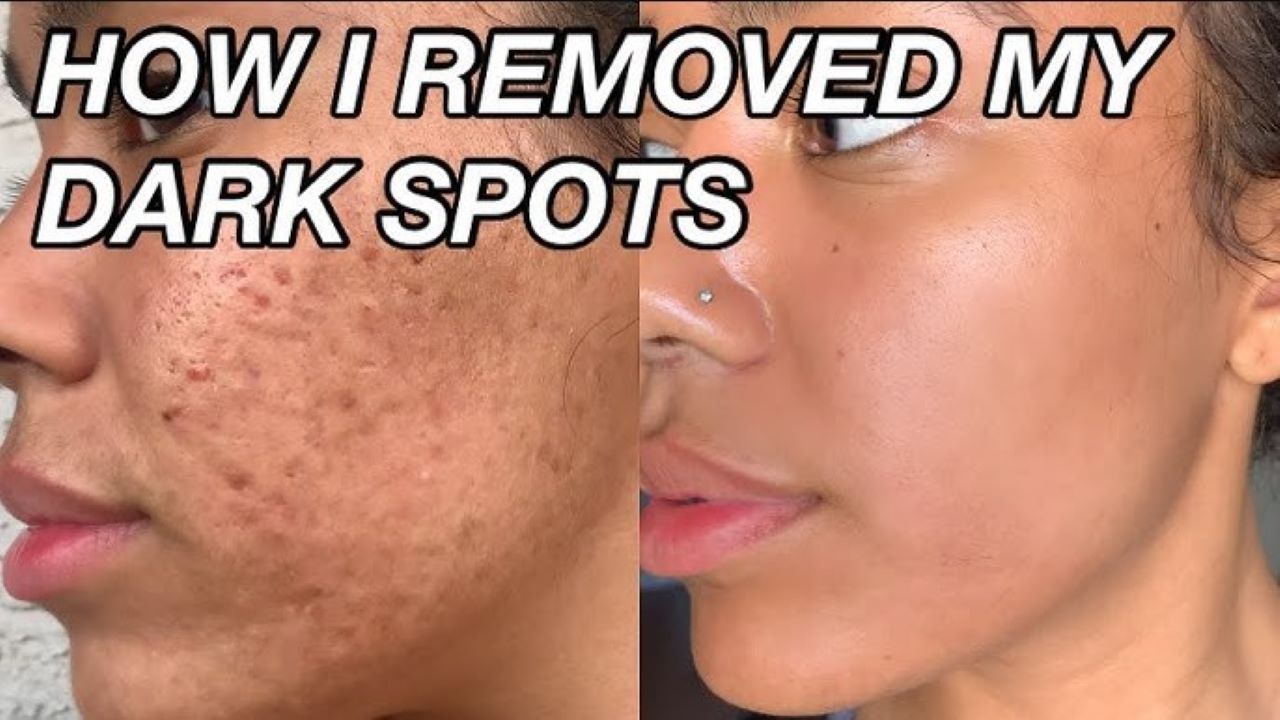 DIY Masker Bekas Jerawat dari Bahan Dapur, 5 Langkah Bikin Wajah Lebih Cerah Tanpa Noda Hitam 