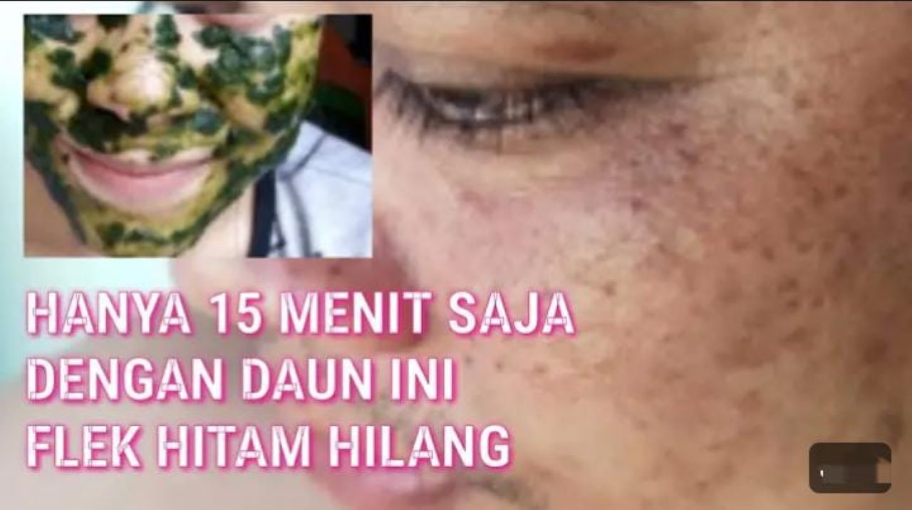 DIY Daun Penghilang Flek Hitam dalam 1 Malam, Begini Cara Meraciknya Agar Glowing Permanen