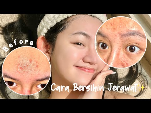 Glowing Mulus Bebas Jerawat, 5 Skincare untuk Atasi Kulit Wajah Kering dan Berjerawat 