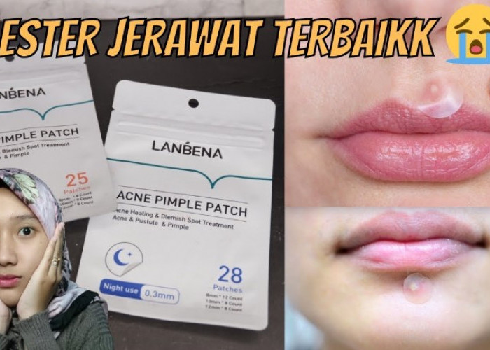 4 Rekomendasi Acne Patch untuk Mempercepat Penyembuhan Jerawat, Solusi Cegah Noda Gelap Parah