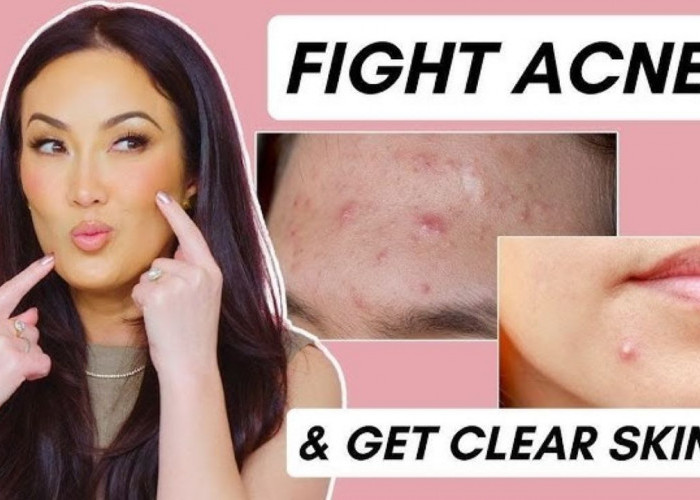 Tips Mengatasi Jerawat dengan Acne Patch Alami, Cuma Butuh 2 Bahan Utama Saja