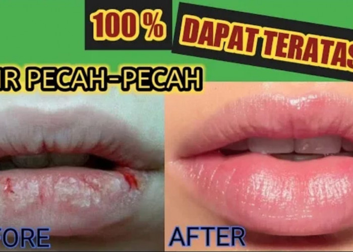 4 Cara Mengatasi Bibir Pecah-Pecah dan Mengelupas Dengan Bahan Dapur, Ampuh Cerahkan Bibir Hitam