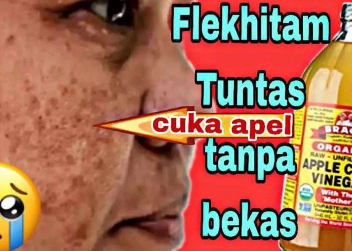 DIY Racikan Cuka Apel Pemutih Wajah Untuk Wajah Glowing, Bonus Hilangkan Flek Hitam