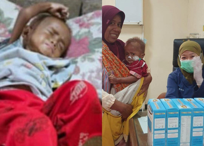 RSUD Batang Kawal 40 Anak dengan Masalah Gizi, Salah Satunya Naik dari 6,1 Kg Jadi 11 Kg