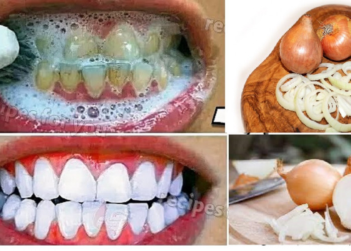 Begini Cara Menghilangkan Karang Gigi dalam Waktu 5 Menit, Efektif Rontokan Karang Gigi Tanpa Pergi Ke Dokter