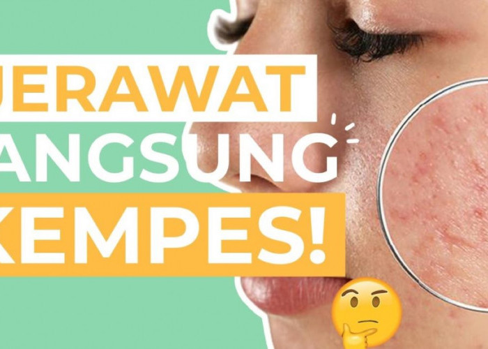 Cuma Semalam! 5 Cara Membuat Jerawat Kempes dengan Cepat, dari Bahan Alami hingga Produk Khusus 